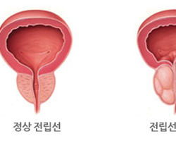 전립선비대증 간호방법