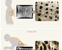골다공증 예방방법