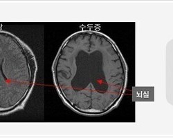 노인성 수두증