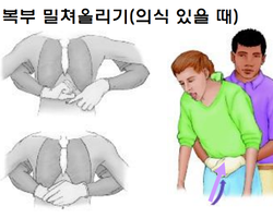 응급상황시 대처방법 (의식이 있는 기도폐쇄환자)