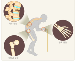 노인 골다공증성 골절