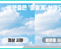 눈앞에 떠다니는 날파리? ‘비문증’