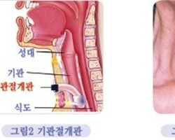 기관 절개관 관리